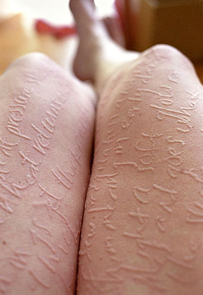 Dermatographia | Allergic Skin Writing